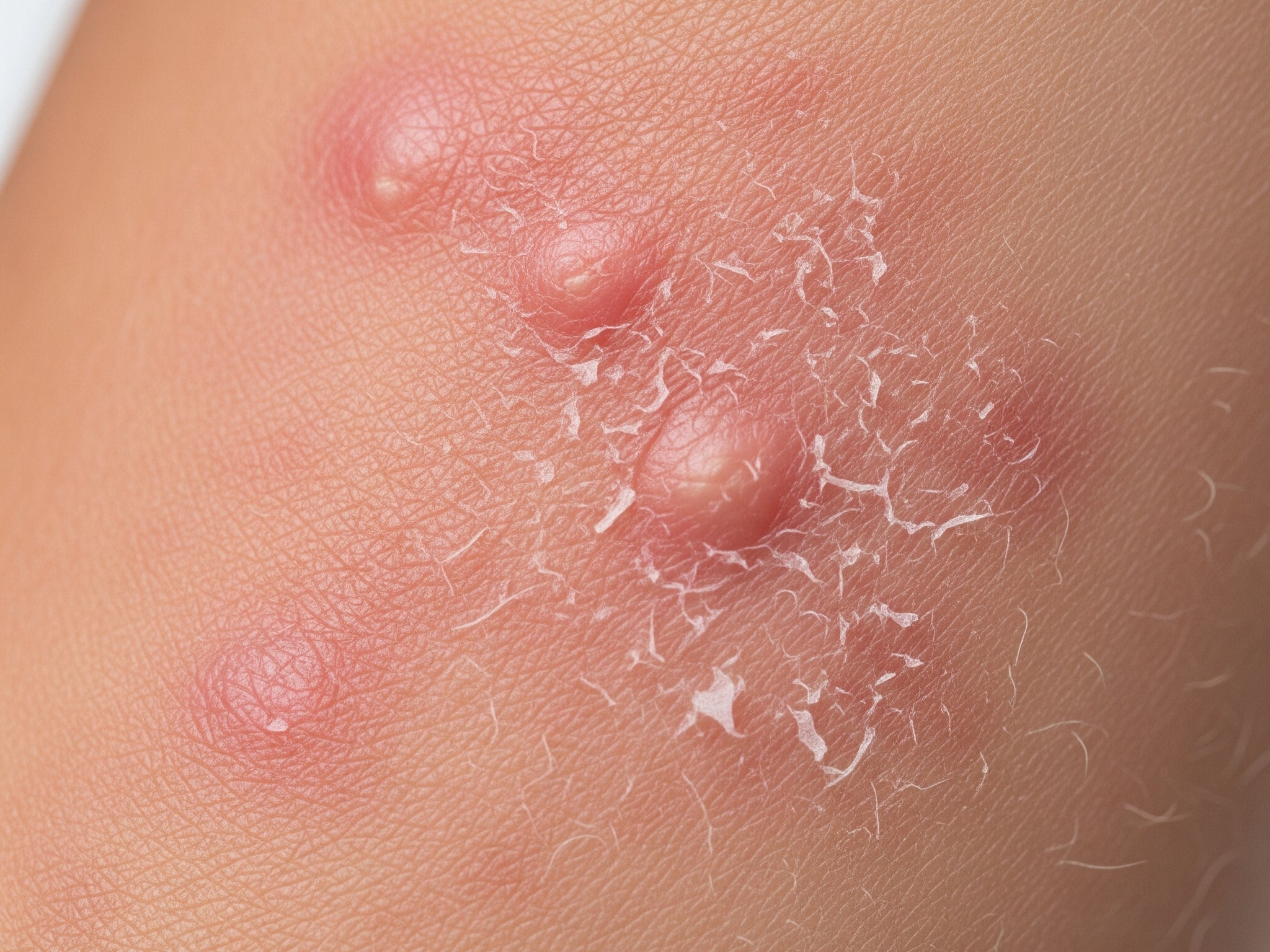 Inflamação crônica da pele: o que é, por que acontece e como evitar o ciclo de sensibilização