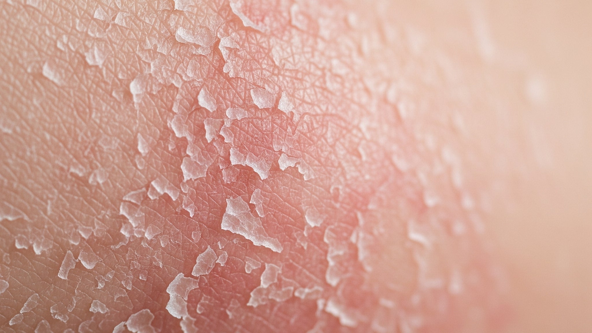 Psoríase e dermatite: como dermocosméticos podem ajudar no manejo da pele